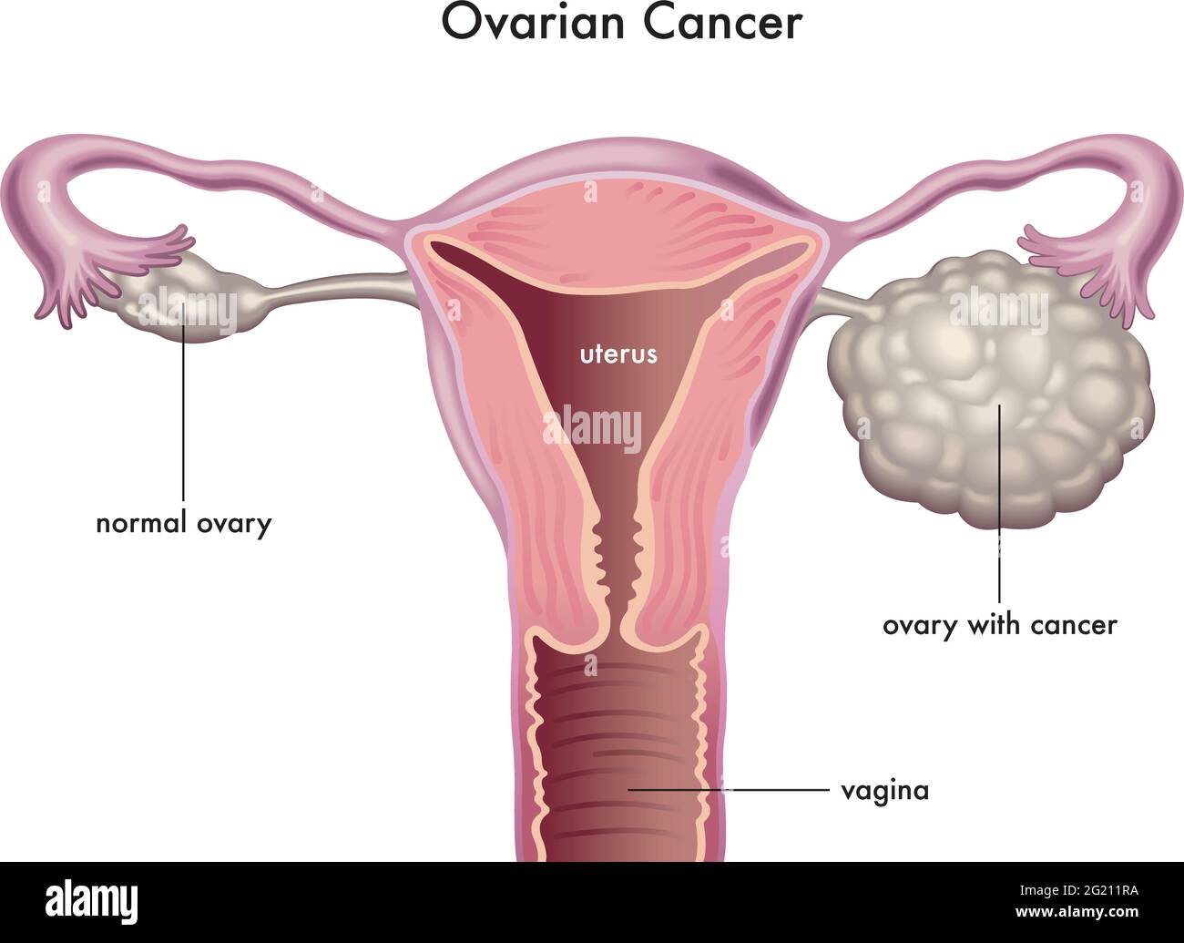 Medical illustration of the symptoms of ovarian cancer. Stock Vector