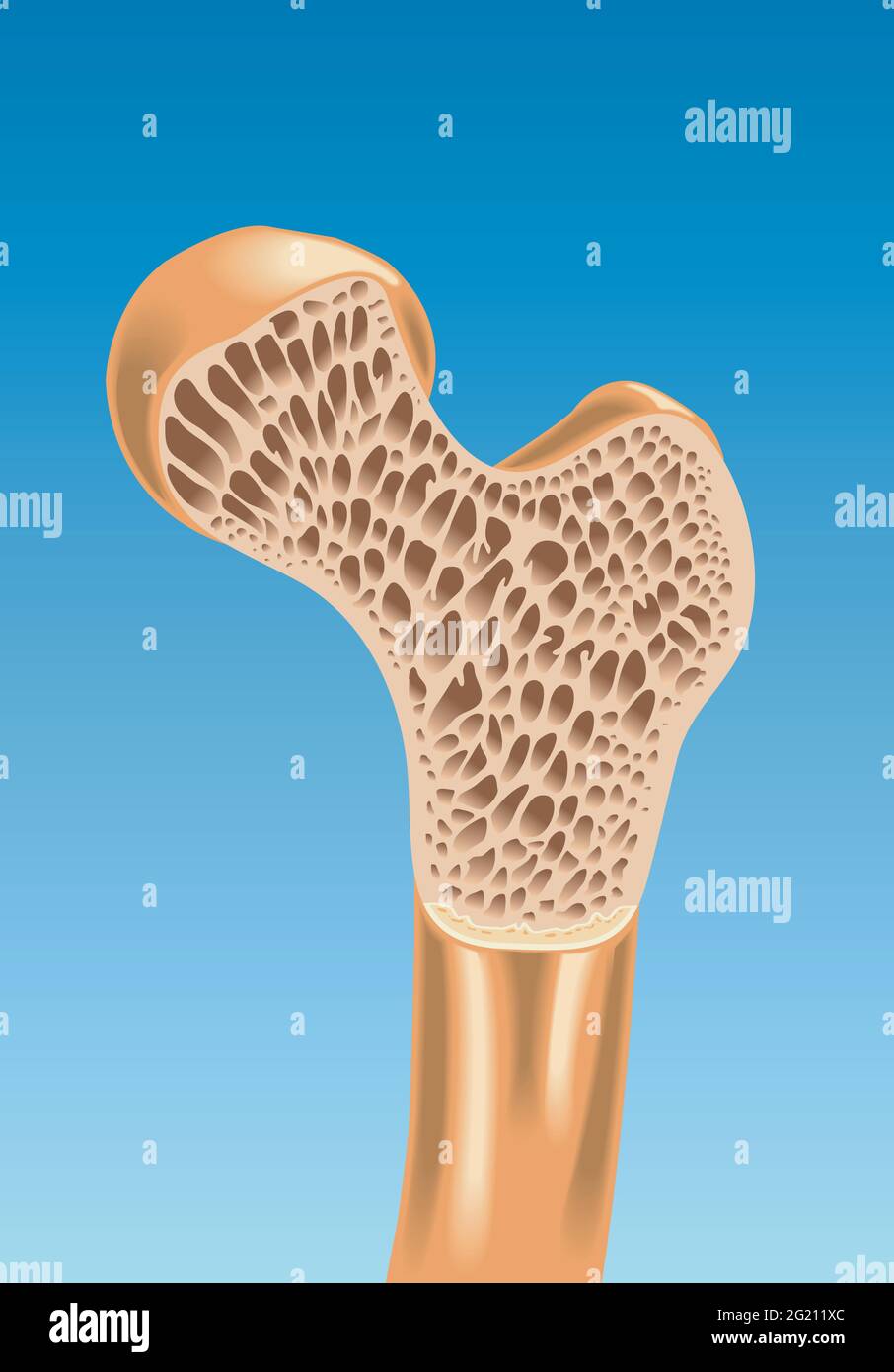 Illustration of a section of femur with osteoporosis. Stock Vector