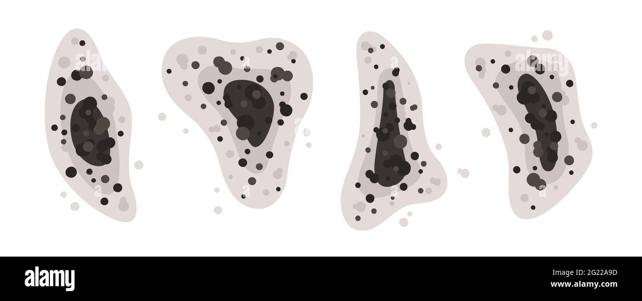 Black mold spots of different shapes. Mucormycosis or black fungus