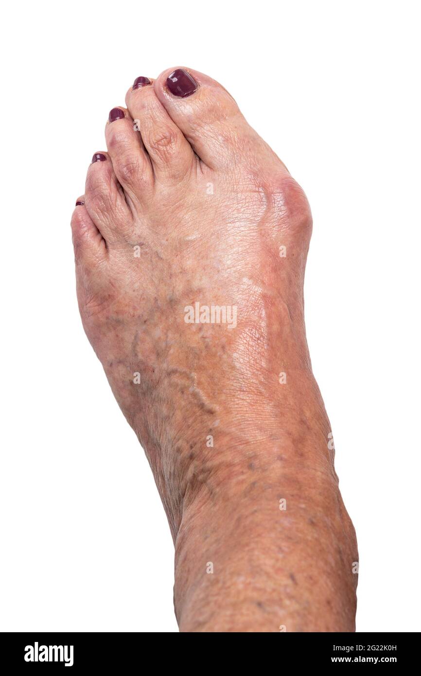 Hallux valgus, bunion on elderly woman's foot isolated on white background. Toe joint deformity with toe misalignment. Painful orthopedic diagnosis. Stock Photo