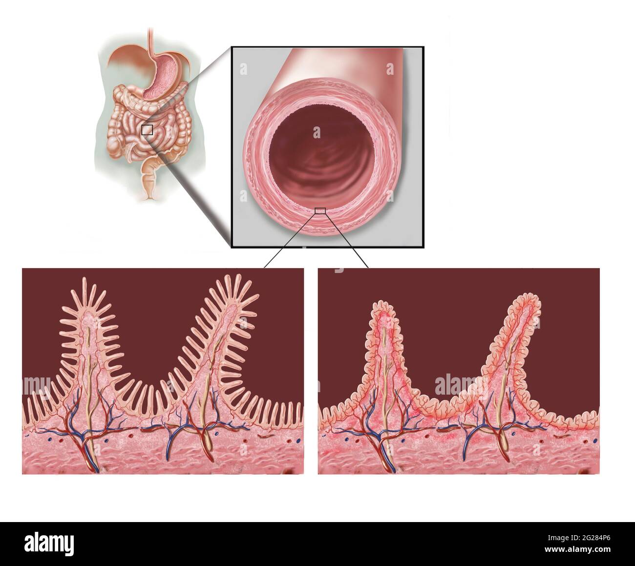 Cross section of intestine showing destruction of villi due to celiac disease. Stock Photo