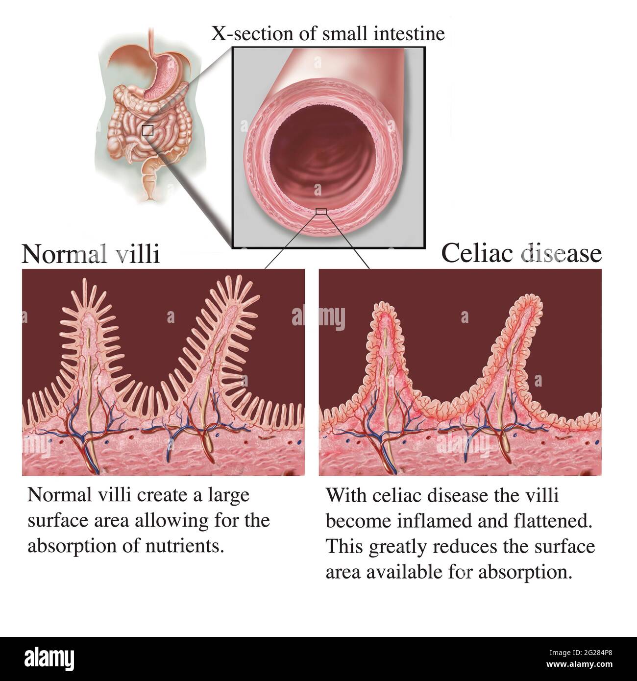 Cross section of intestine showing destruction of villi due to celiac disease, with text description. Stock Photo