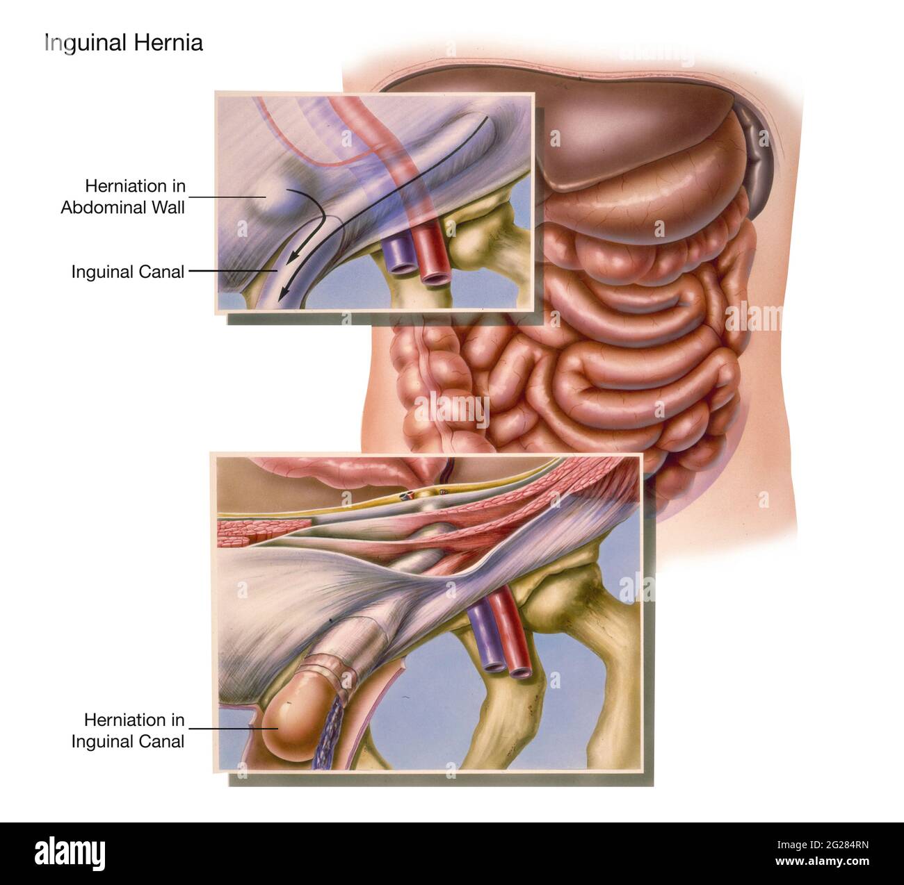 Detail of an inguinal hernia. Stock Photo