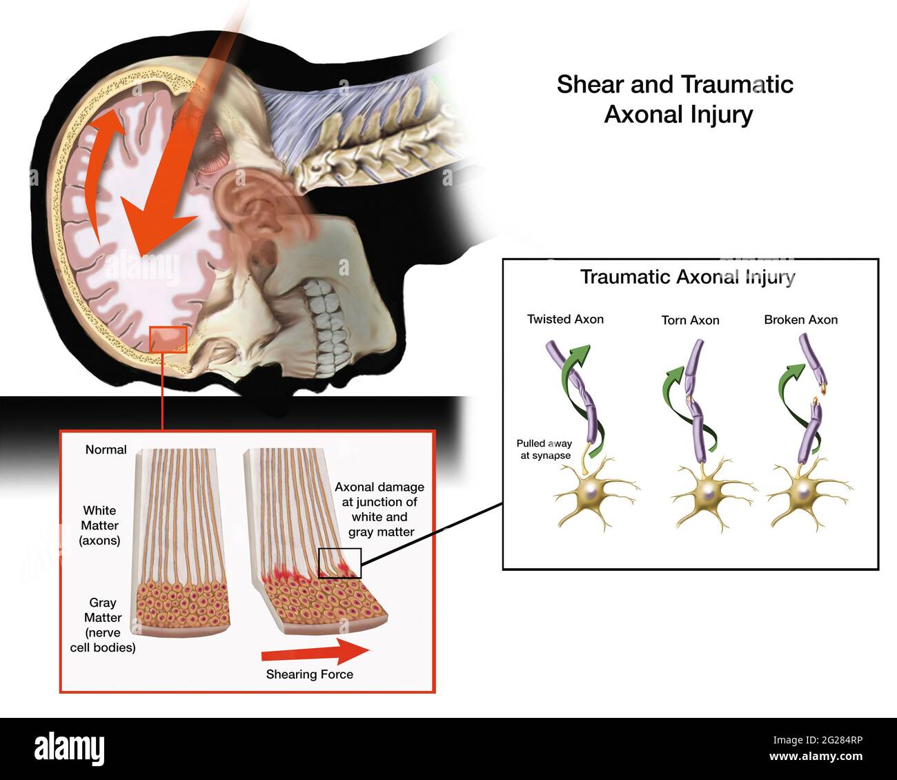 Brain impacting on skull. Detail of shear and traumatic axonal injury. Stock Photo