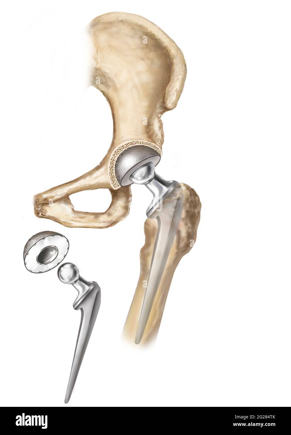 Detail of hip replacemnt. Stock Photo