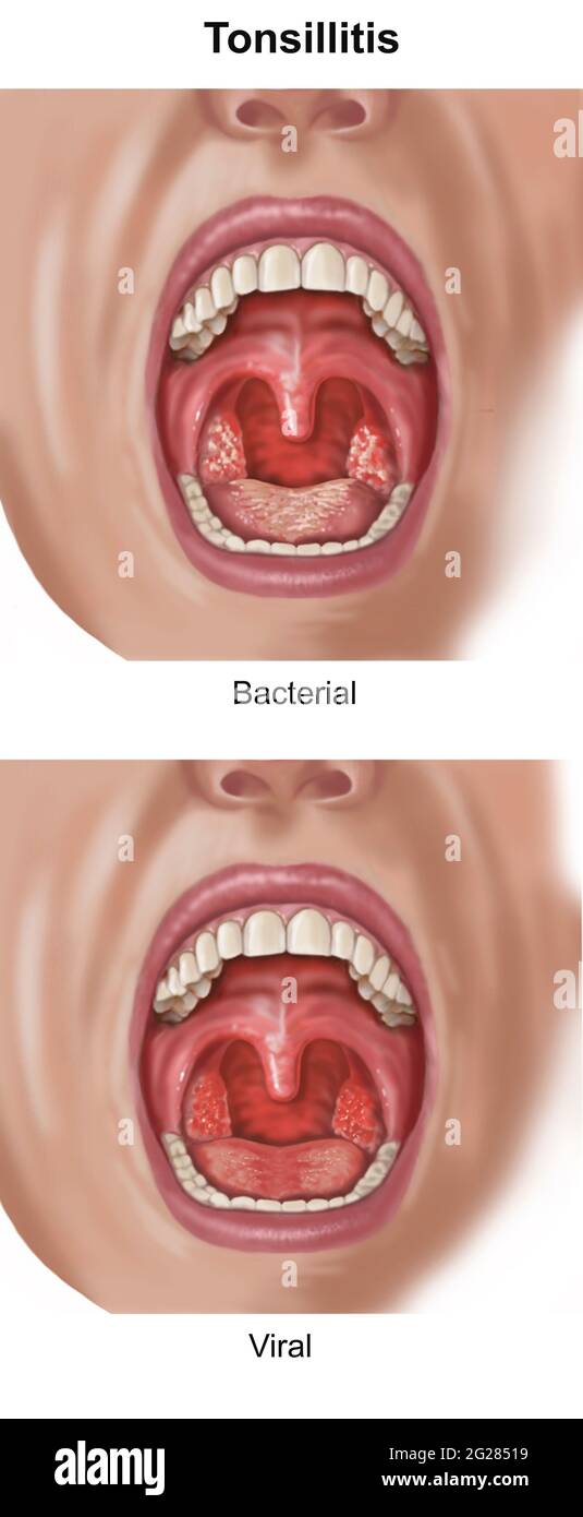 Open mouth view showing signs of bacterial vs. viral tonsilitis. Stock Photo