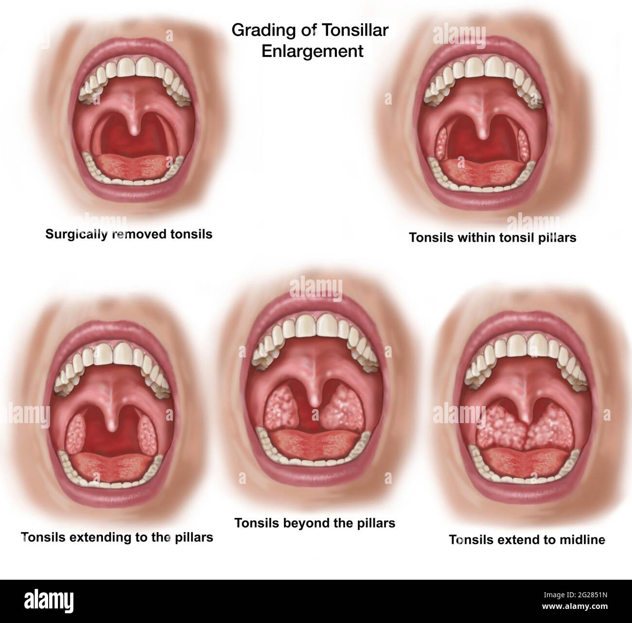 Various stages of tonsillar enlargement, looking into an open mouth. Stock Photo