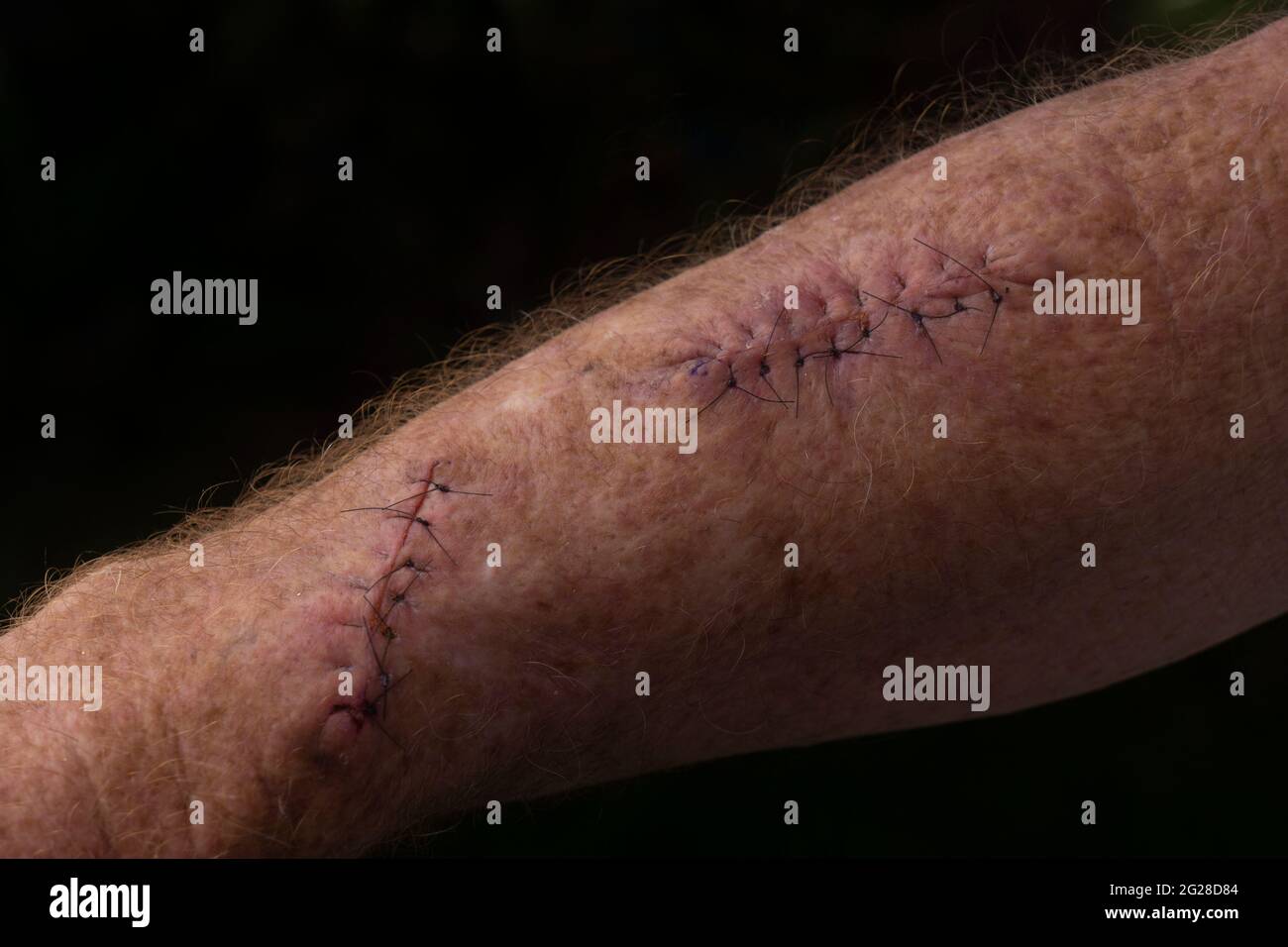 Surgery wounds with sutures and stitches after an operation on the arm of a senior male to remove squamous cell carcinomas or skin cancers which are t Stock Photo
