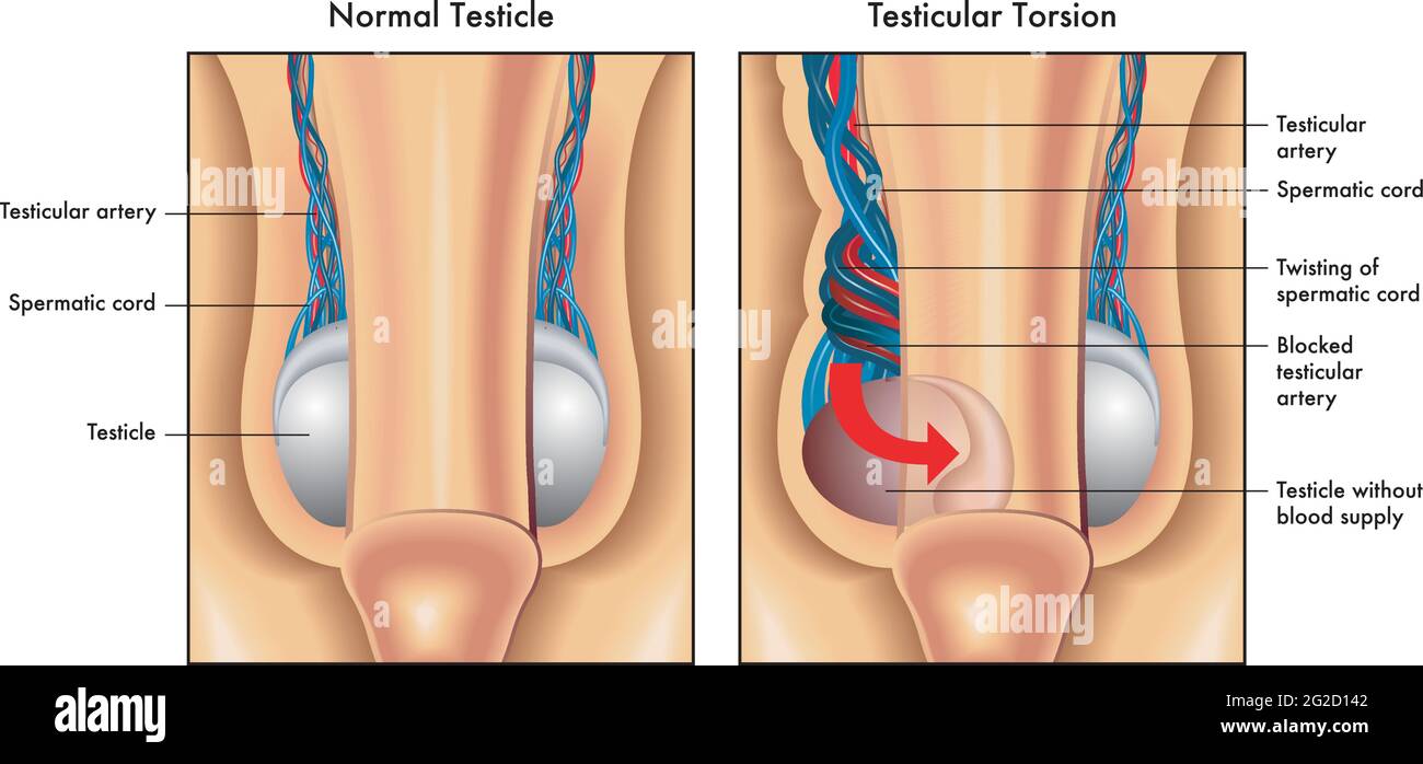 Medical illustration shows a normal testicle and one affected by testicular torsion, with annotations. Stock Vector