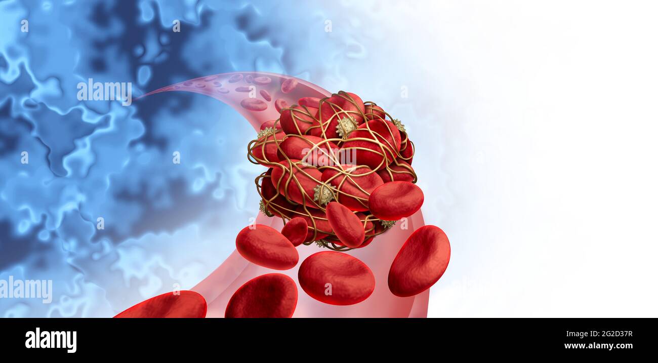 Blood clots health risk or thrombosis medical illustration concept symbol as a group of human blood cells clot clumped together by sticky platelets. Stock Photo