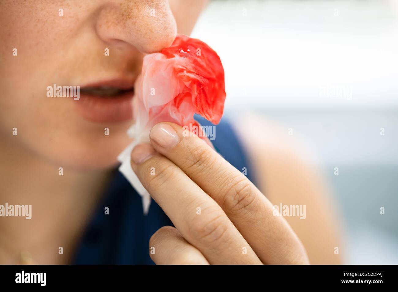 Woman nosebleed hires stock photography and images Alamy
