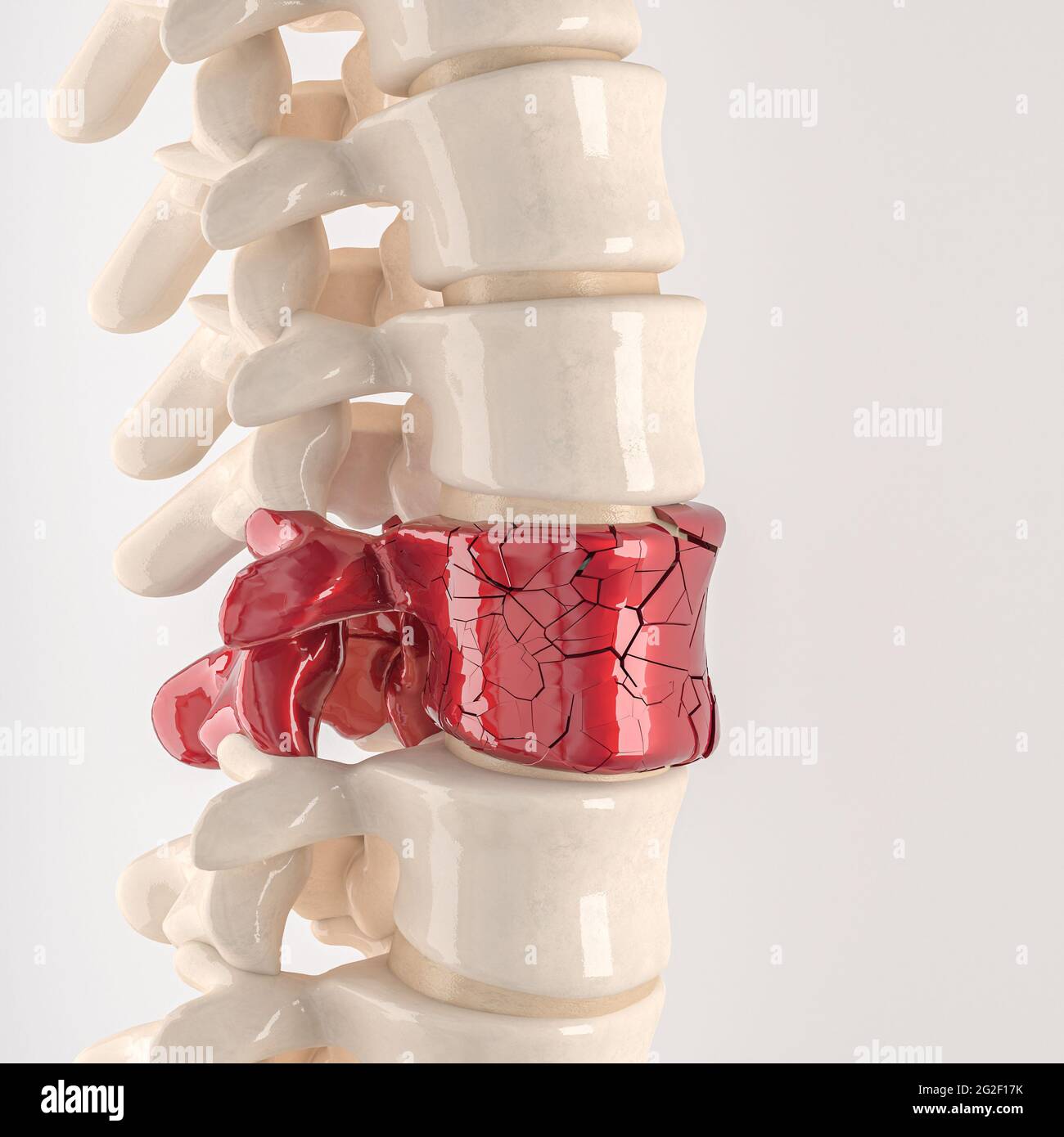 spine with shattered vertebrae. concept of physical discomfort. 3d render Stock Photo