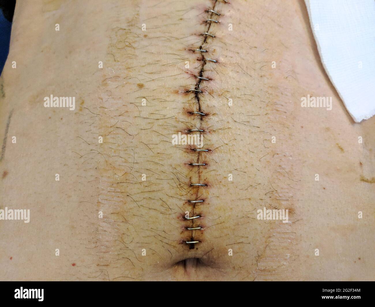 Rectal Cancer Incision after Surgery. Gastrointestinal wound . Operation of obstruction of rectal cancer Stock Photo