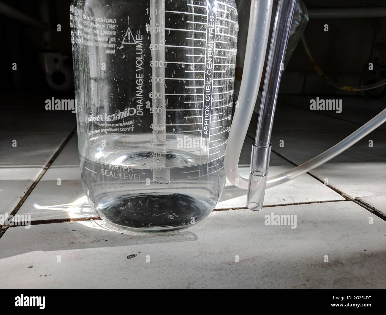 Pneumothorax Chest Drain Chest connected to a fluidfilled bottle with