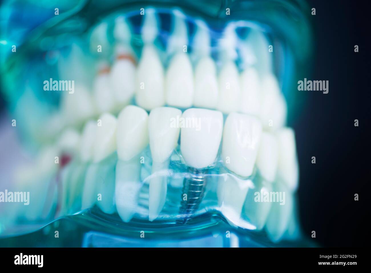 Dental tooth implant titanium prosthetic dentists model Stock Photo Alamy