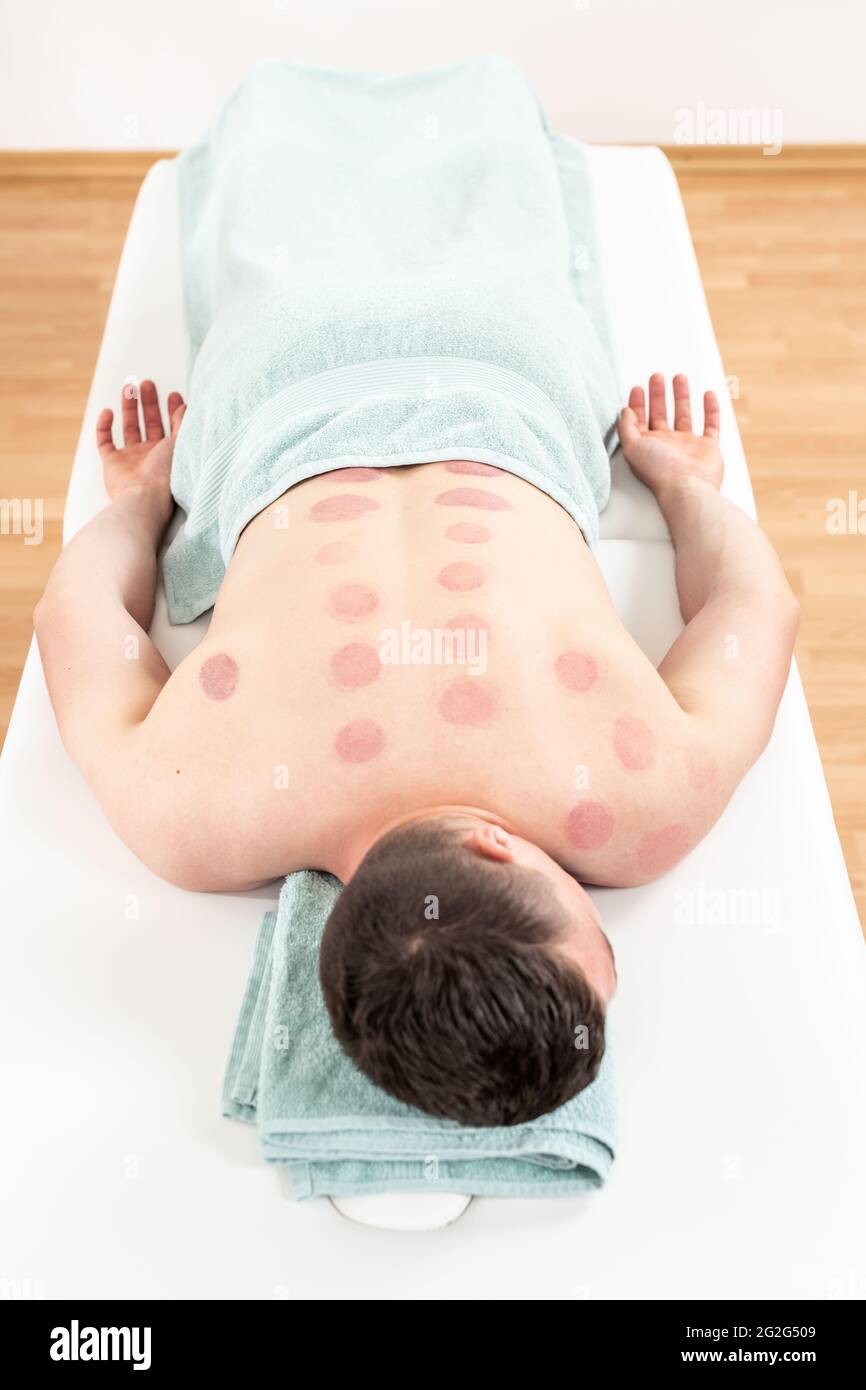 Young man relaxing after vacuum cupping therapy. High angle view of a