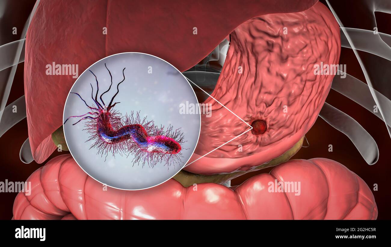 Gastric ulcer and Helicobacter pylori bacteria, illustration Stock Photo