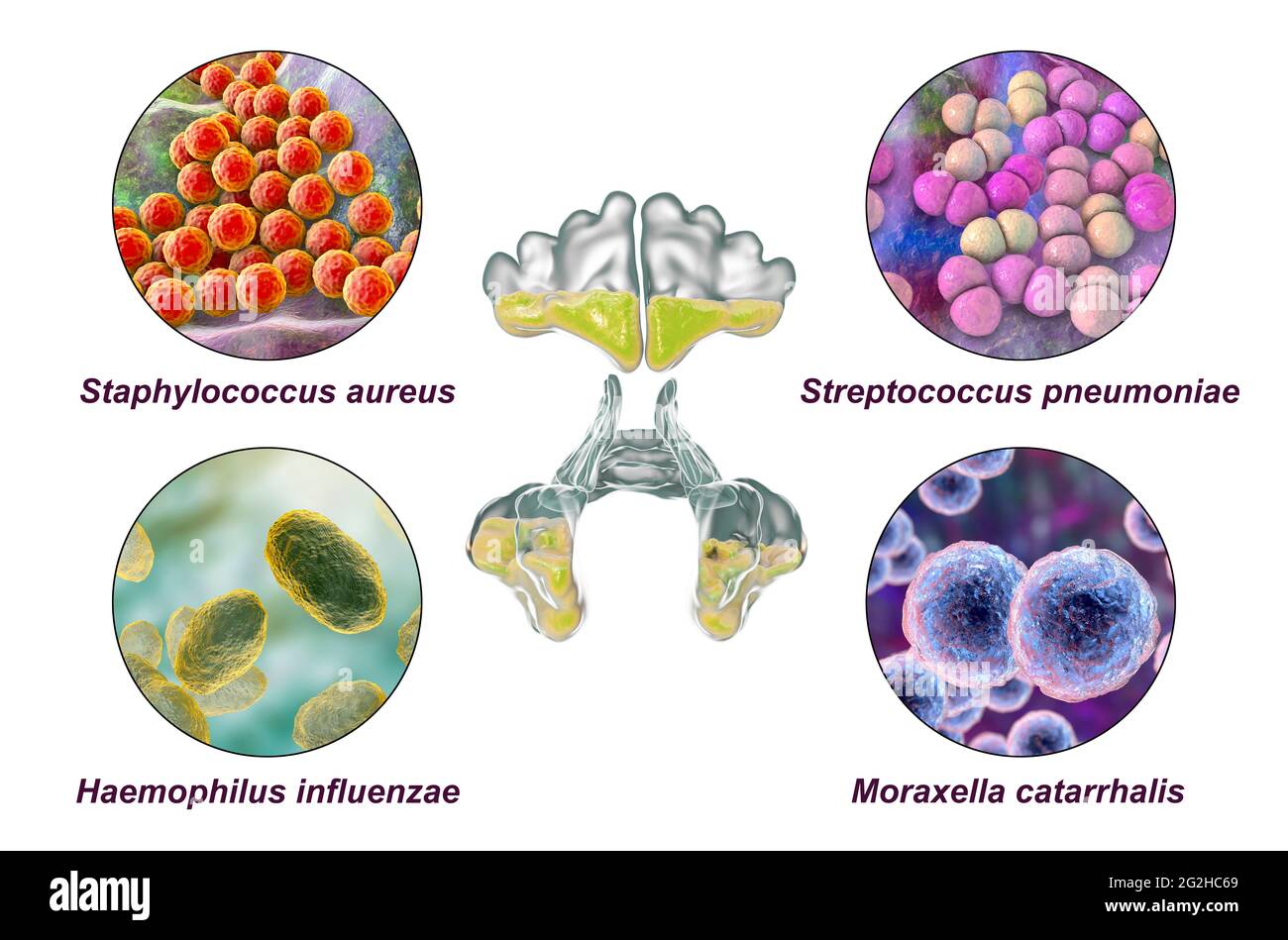 Sinusitis, illustration Stock Photo