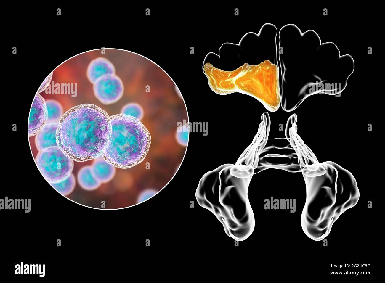 Sinusitis, illustration Stock Photo