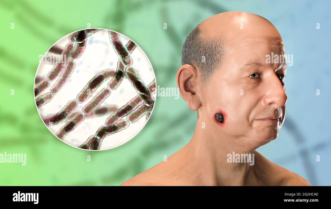 Cutaneous Anthrax Illustration Stock Photo Alamy