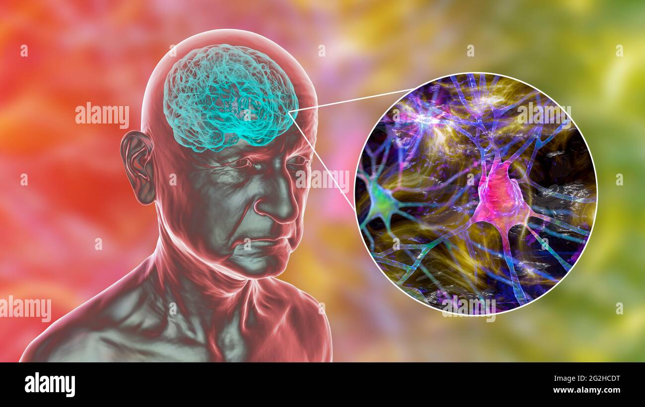 Dementia concept brain hi-res stock photography and images - Alamy