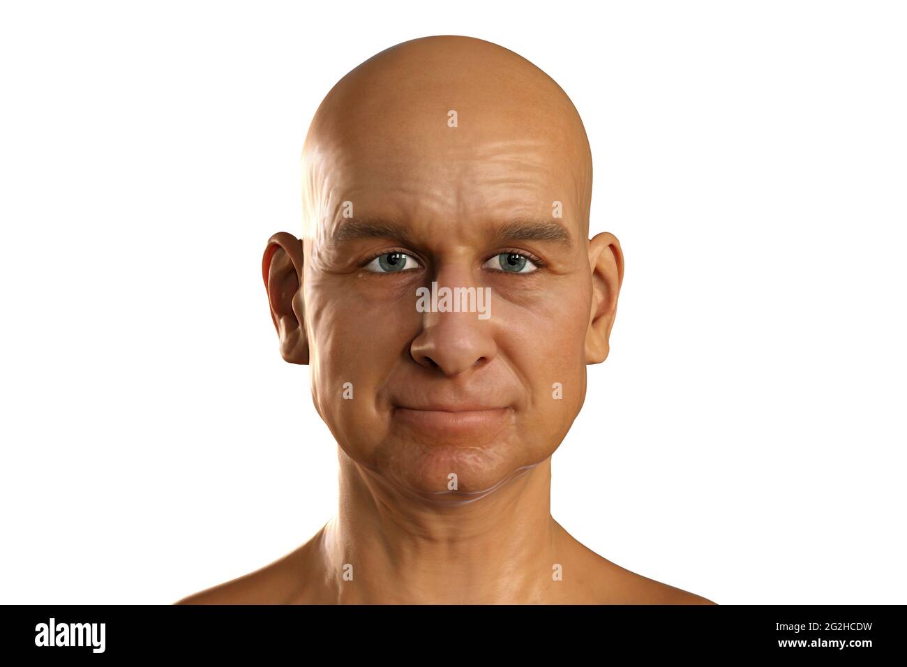 Man without hair on head