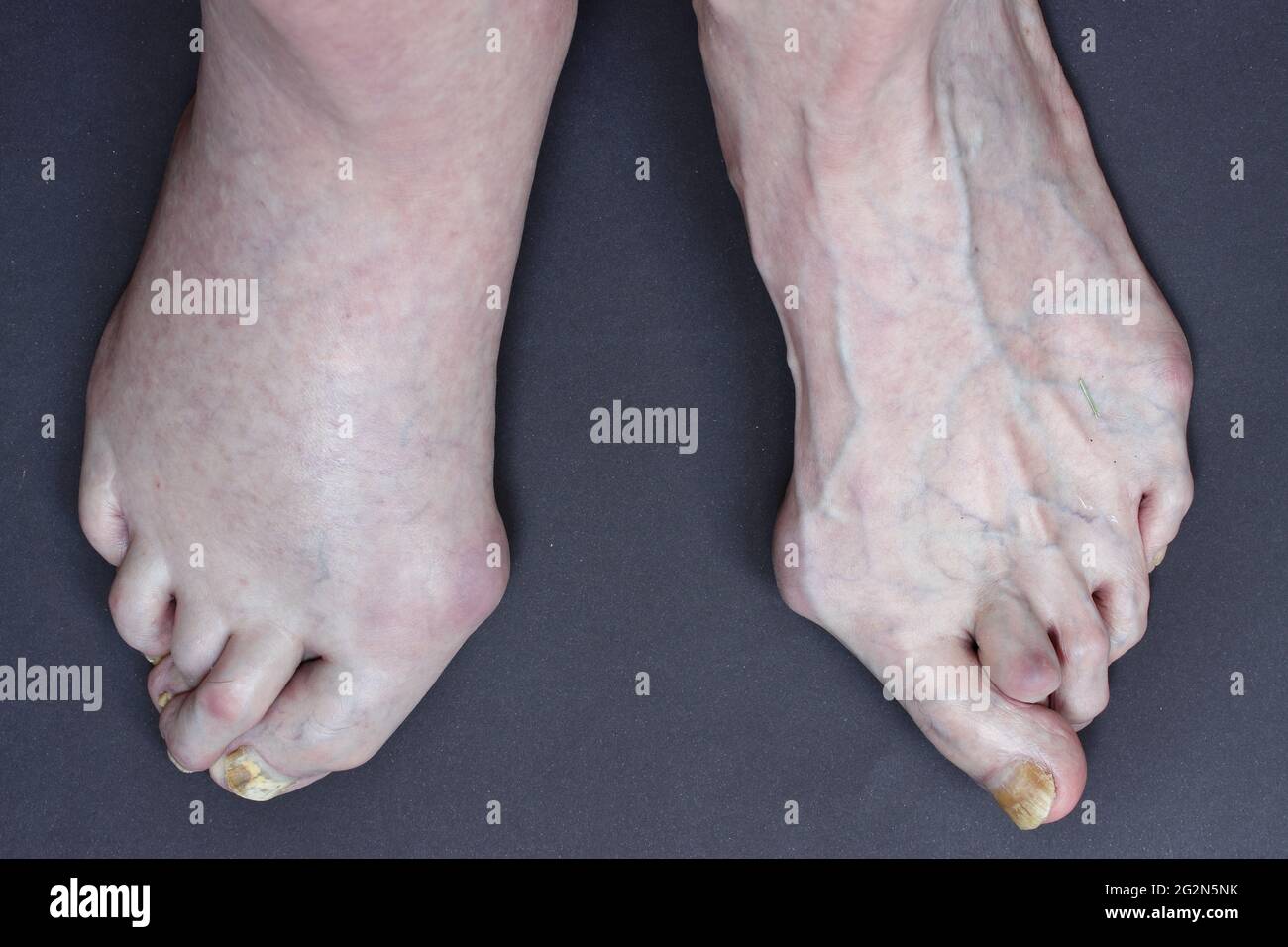 Three problems in a 74-year-old man: deformity of human foot - hallux valgus, diagnosed thrombosis on right leg and fungal nail infections Stock Photo