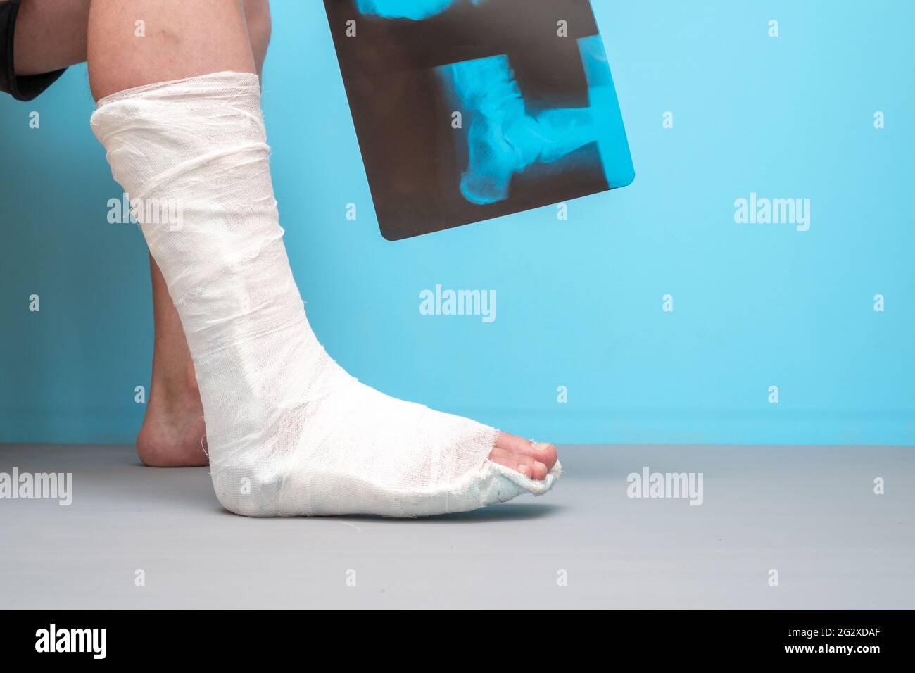 Legs of a man with a broken leg on a blue background. X-ray image of ankle fracture , broken ankle , pott fracture fix by open surgery and metal plate Stock Photo