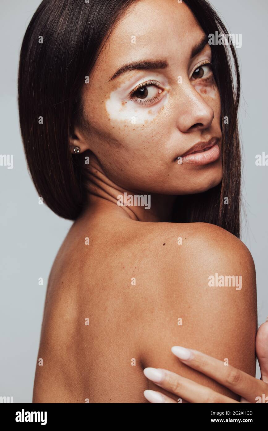 Side view portrait of a woman having vitiligo. Close up of a confident young woman with unique skin. Stock Photo