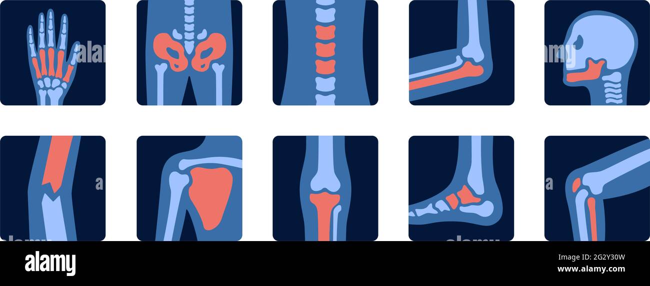 Xrays of human joint anatomy with pain parts. Xray examination of bones. Medical and science