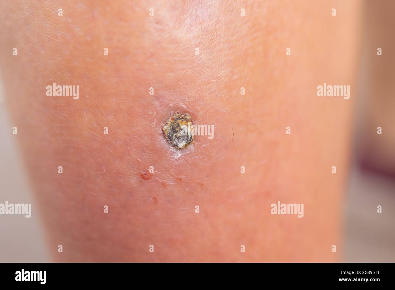 Pimple Folliculitis on buttock caused by infection from bacteria, yeast