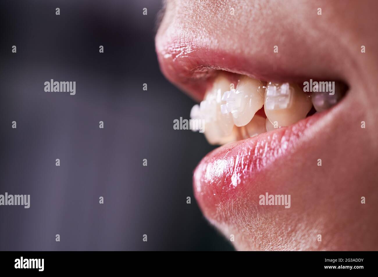 Close up of smiling woman with opened mouth demonstrating white teeth with orthodontic brackets. Female patient at dental braces treatment. Concept of orthodontic treatment and stomatology. Stock Photo