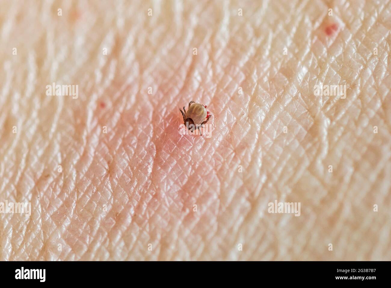 Engorged, feeding adult female deer tick, Ixodes scapularis, laying red eggs, protruding under it's body, sucking blood from skin of human female. Stock Photo