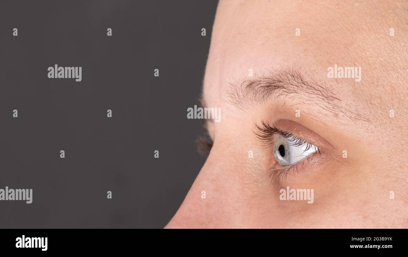 the eye of a woman diagnosed with keratoconus,corneal dystrophy. Stock Photo