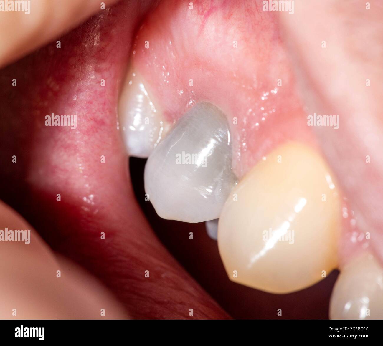 Gray darkened tooth after nerve removal and pulpitis disease. Lack of