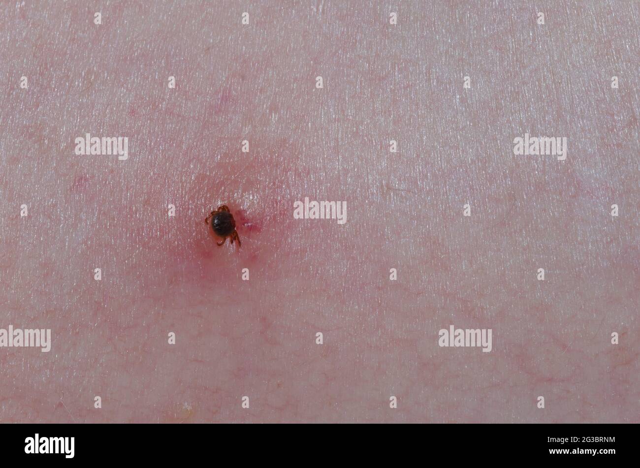 Lone Star Tick, Amblyomma americanum, nymph attached to human skin Stock Photo