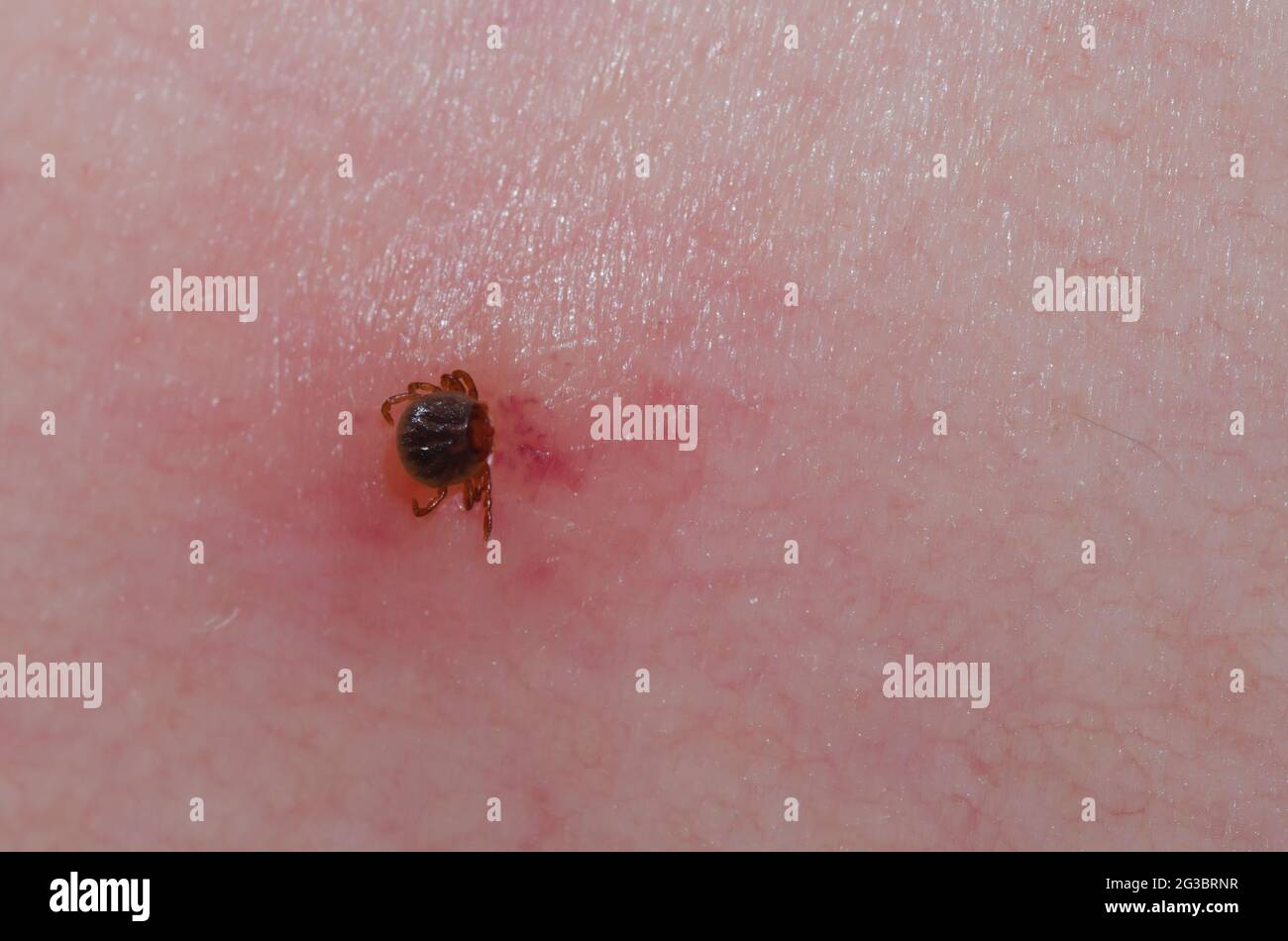 Lone Star Tick, Amblyomma americanum, nymph attached to human skin Stock Photo