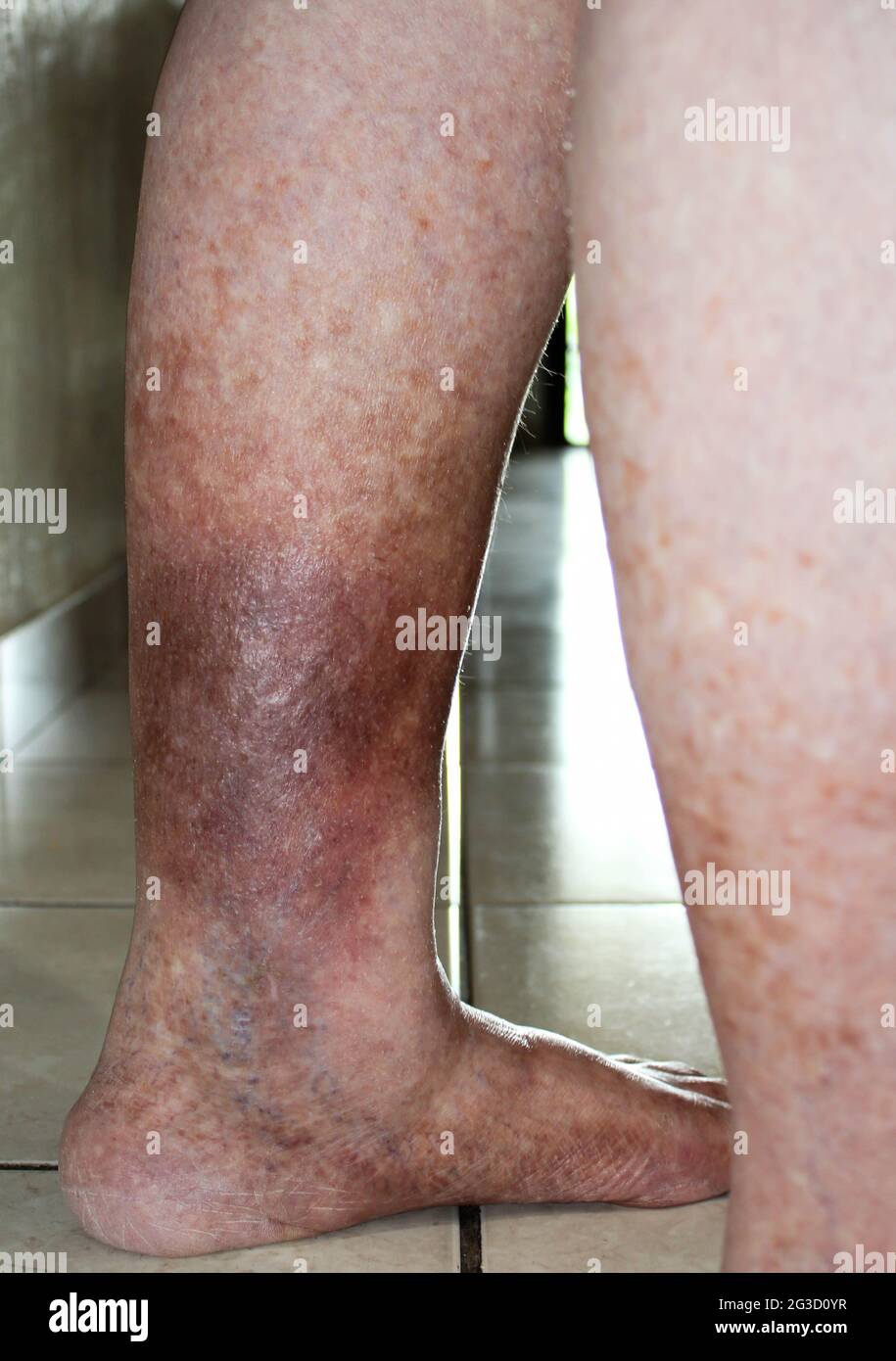 Leg suffering from Chronic Venous Insufficiency with mild cellulitis in her legs. Trying to walk and exercise to reduce heaviness swelling pain redness Stock Photo