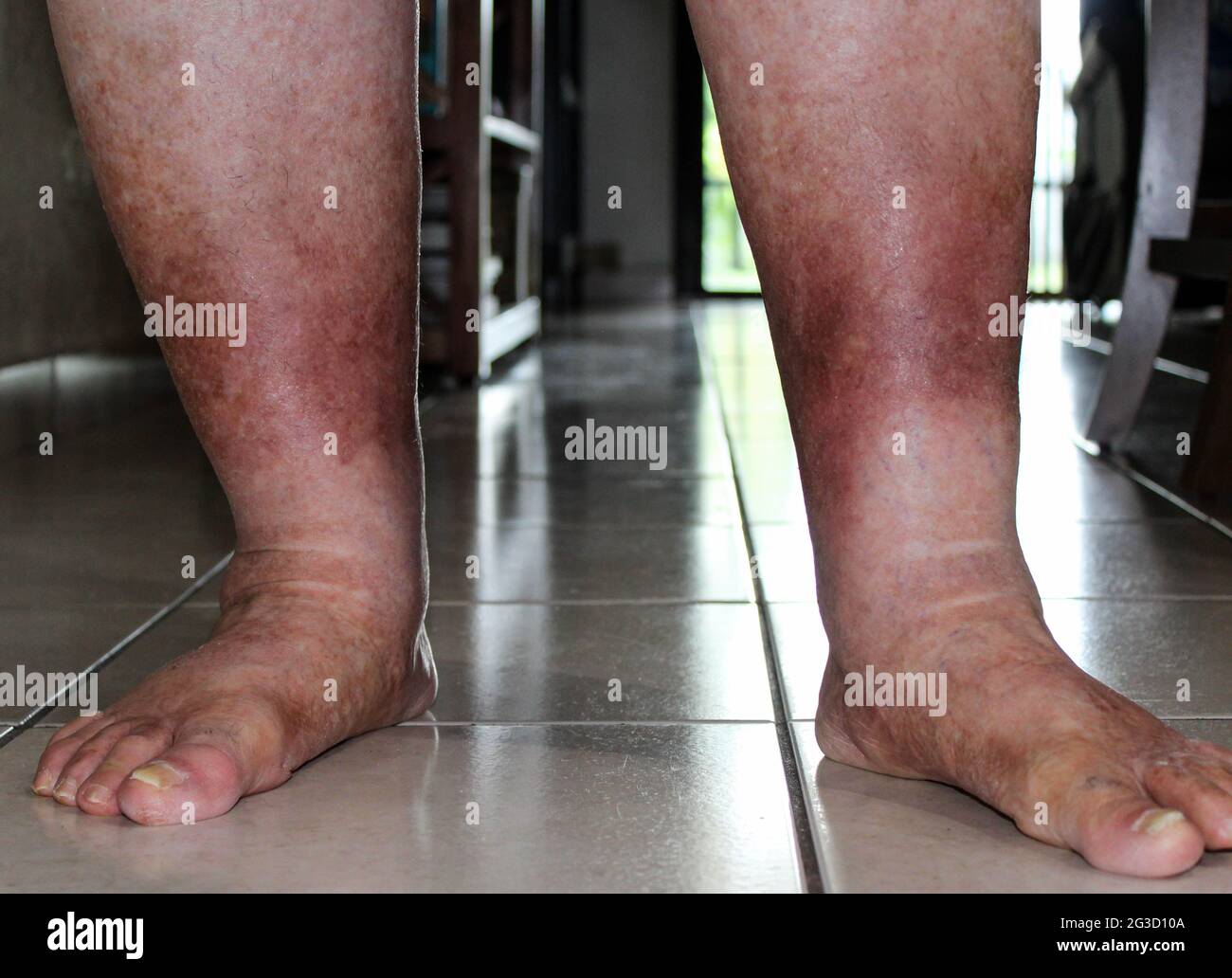 Leg suffering from Chronic Venous Insufficiency with mild cellulitis in her legs. Trying to walk and exercise to reduce heaviness swelling pain redness Stock Photo