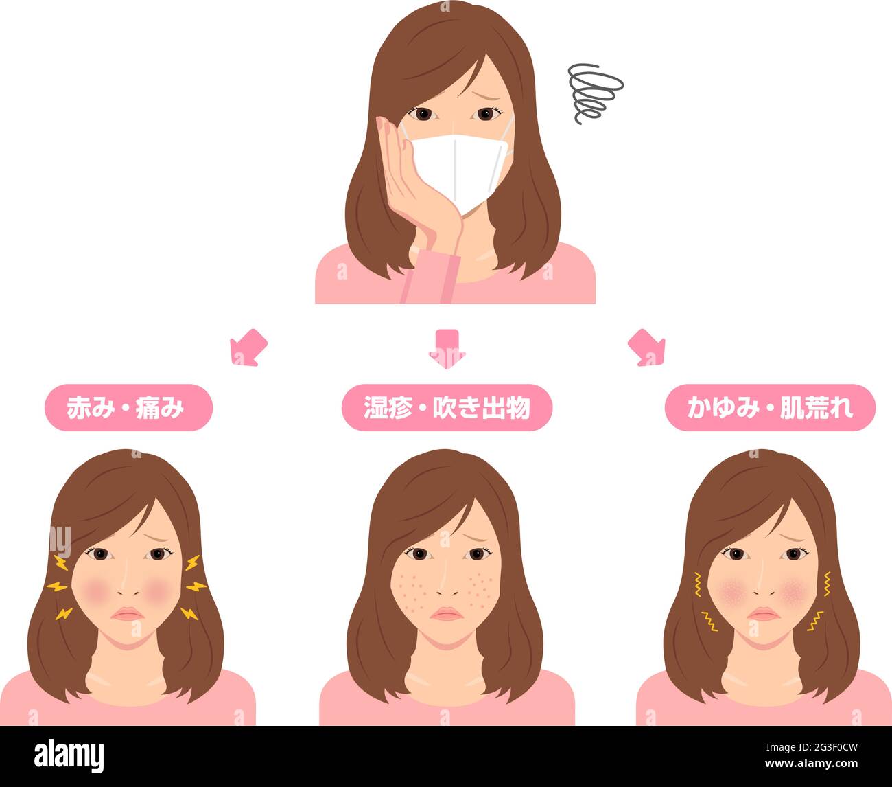 Vector illustration of skin troubles caused by wearing a mask. Stock Vector