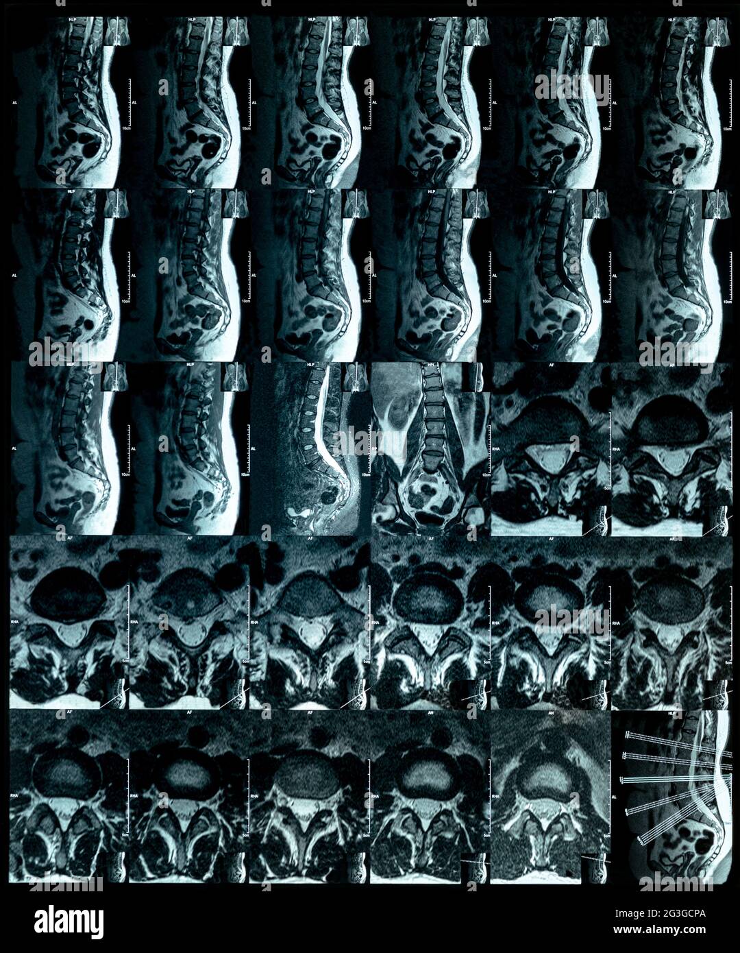 Magnetic resonance imaging spine discs protrusion laboratory film Stock Photo