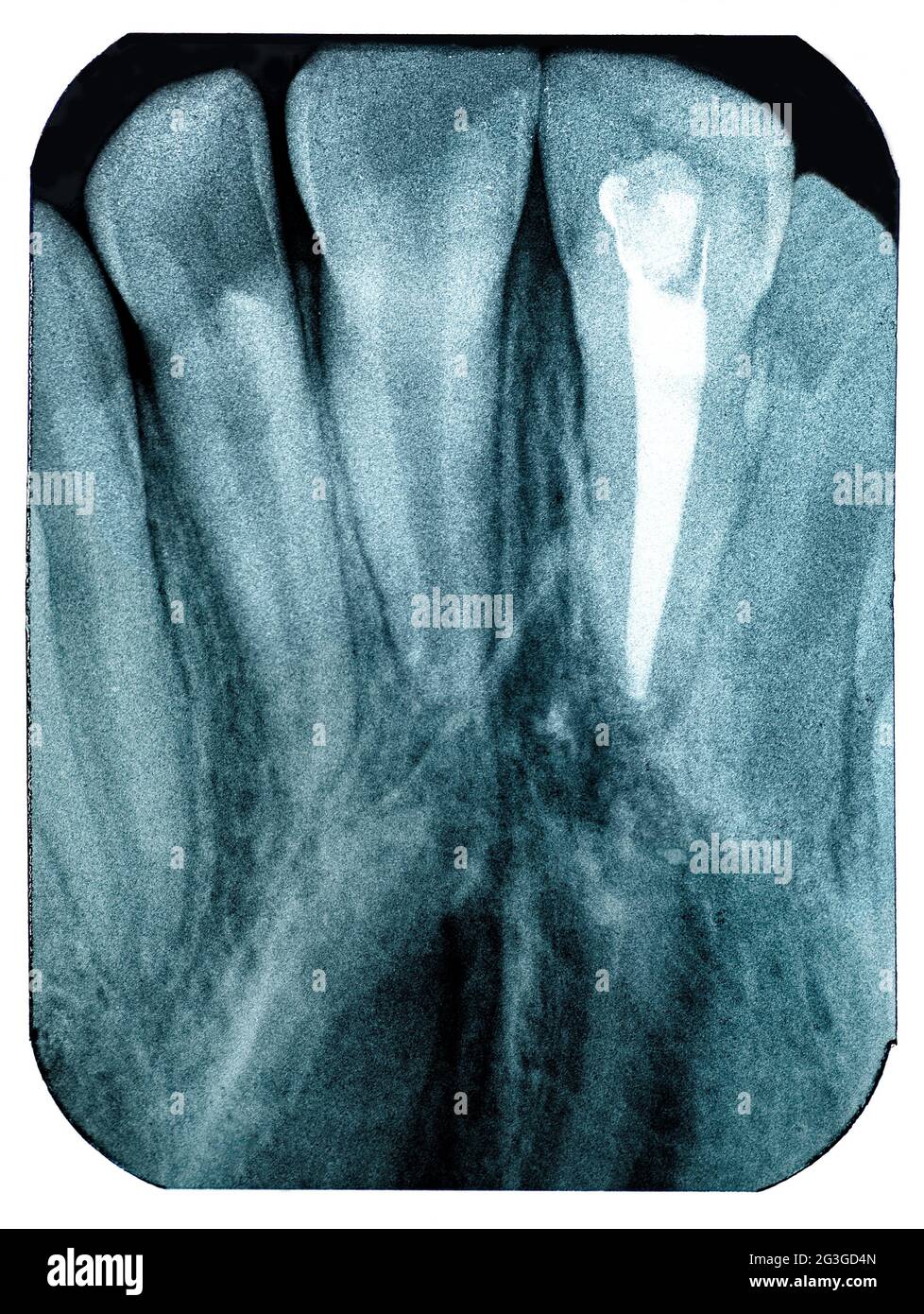 Radiography imaging teeth upper canines root canal laboratory film Stock Photo