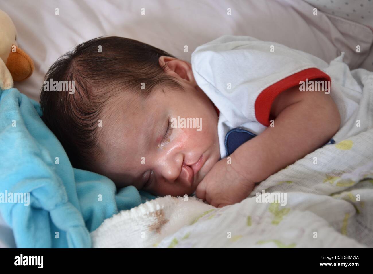 Baby with Cleft lip and cleft palate. Stock Photo