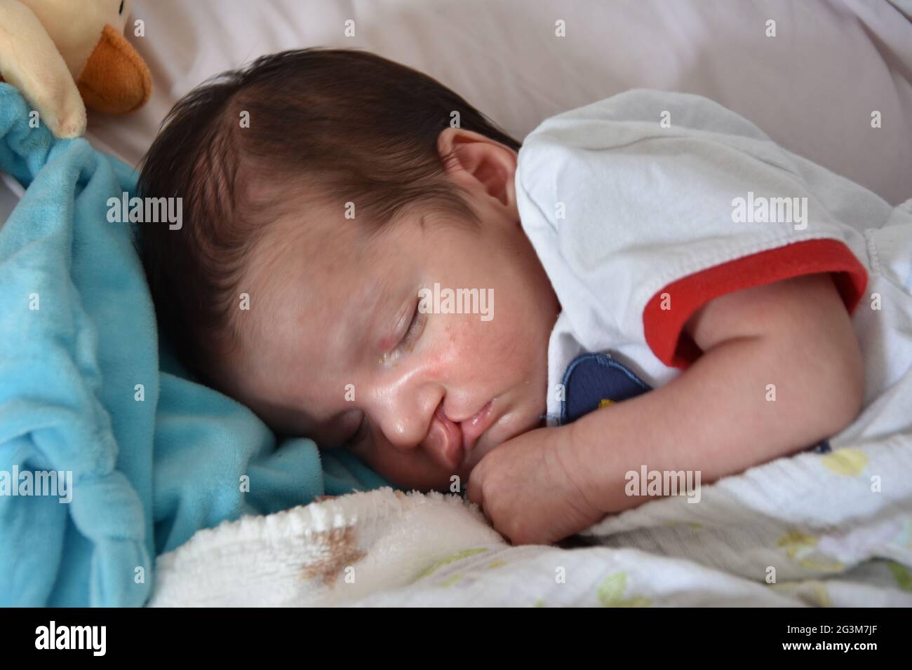 Baby with Cleft lip and cleft palate. Stock Photo