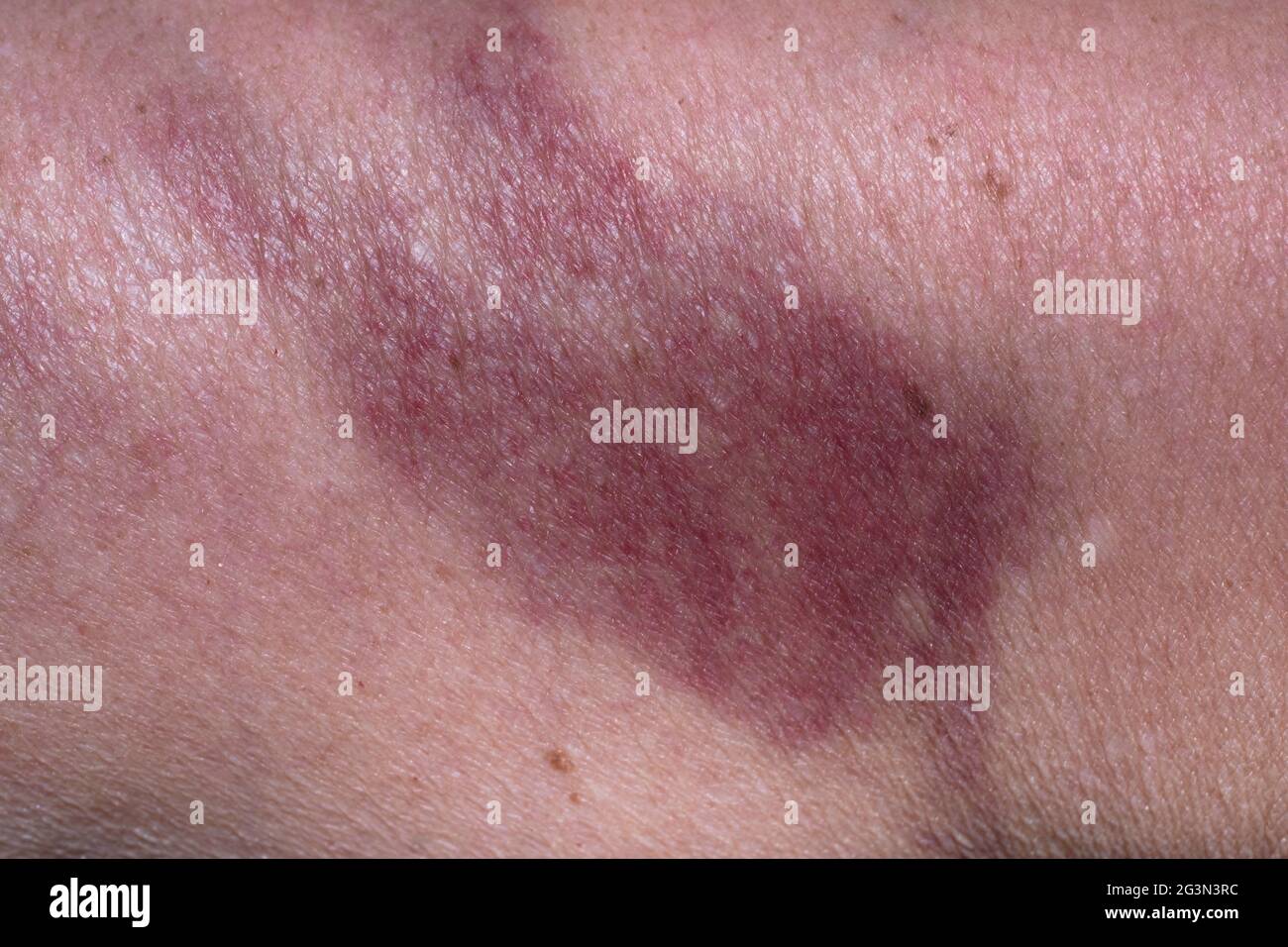 Bruise on the skin of a woman's upper arm, caused by an injury or domestic violence Stock Photo