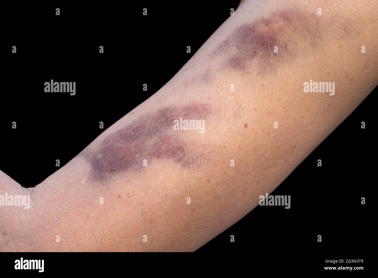 Bruise on the skin of a woman's upper arm, caused by an injury or domestic violence. Isolated on black Stock Photo