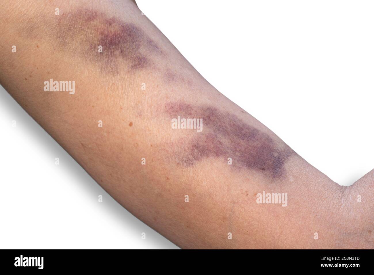 Bruise on the skin of a woman's upper arm, caused by an injury or domestic violence. On white background Stock Photo