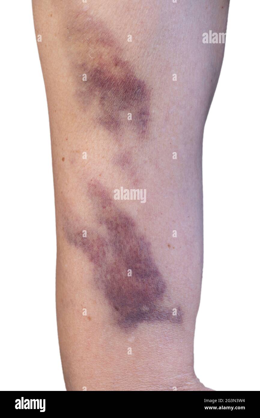 Bruise on the skin of a woman's upper arm, caused by an injury or domestic violence. Isolated on white background. Vertical image Stock Photo