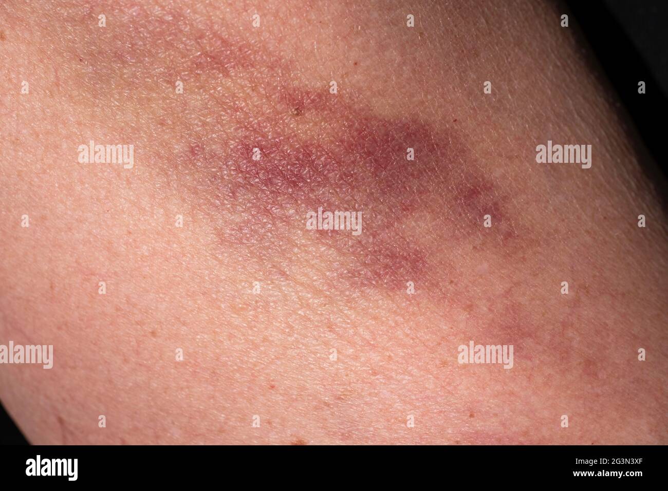 Bruise on the skin of an upper arm of a man or woman, caused by domestic violence. Black background Stock Photo