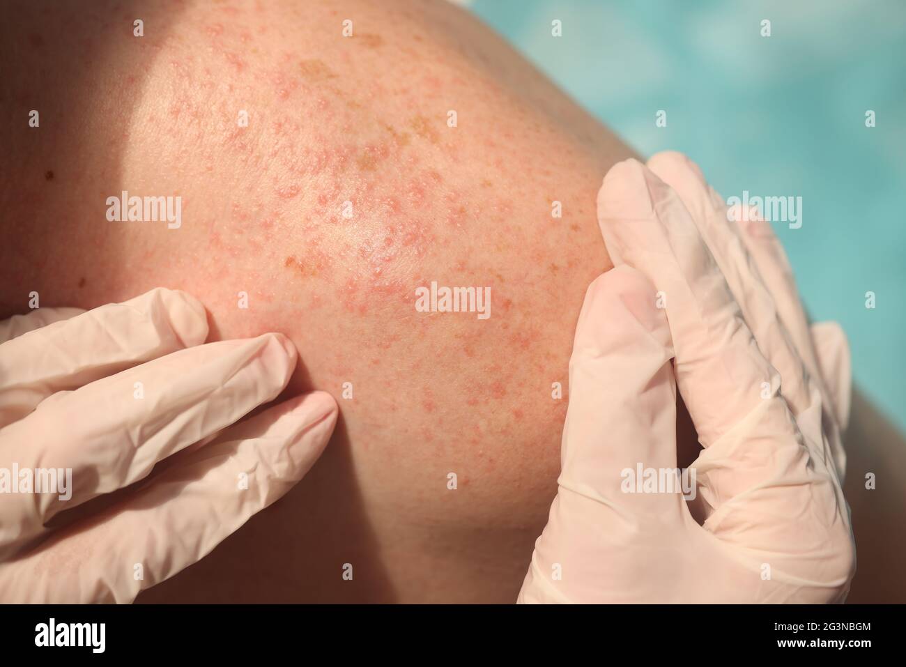 Doctor in rubber gloves examining skin of patient with red rash in clinic closeup Stock Photo
